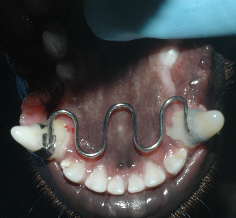 Orthodontie-Helix-end